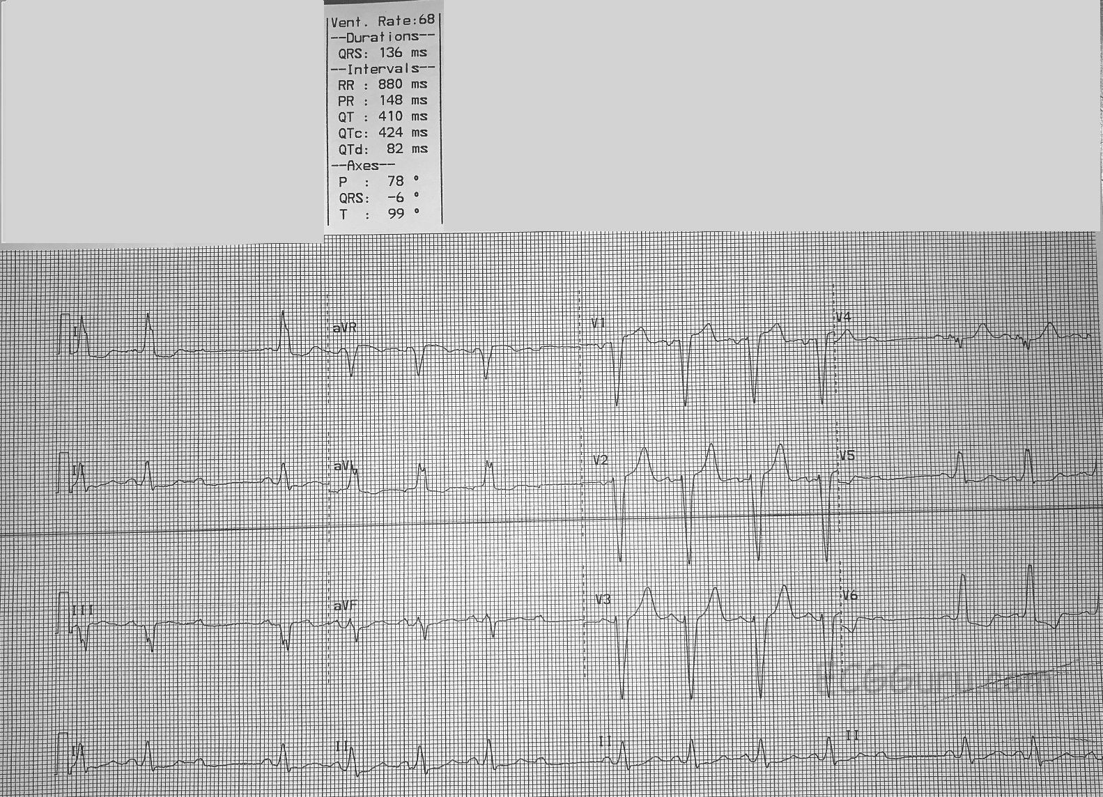 Second Degree Av Block Type Ii Ecg Guru Instructor Resources Second Degree Av Block Type Ii Ecg Guru Instructor Resources